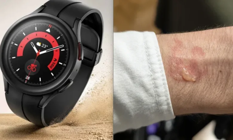 Владельцы Samsung Galaxy Watch жалуются на перегрев и раздражение кожи во время сна